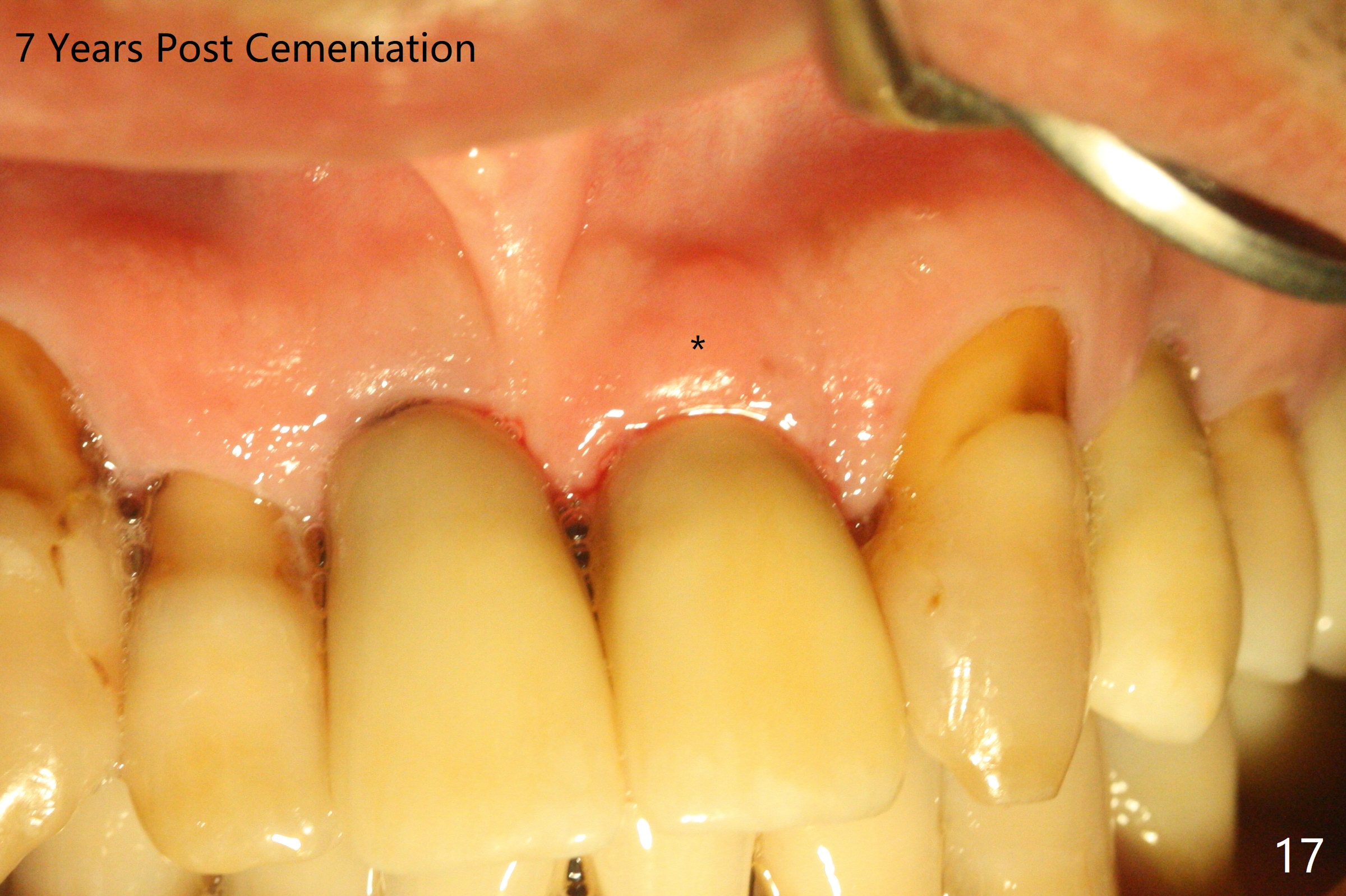 How immediate implants achieve primary stability after extraction of